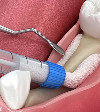 Closeup digital image of a bone graft