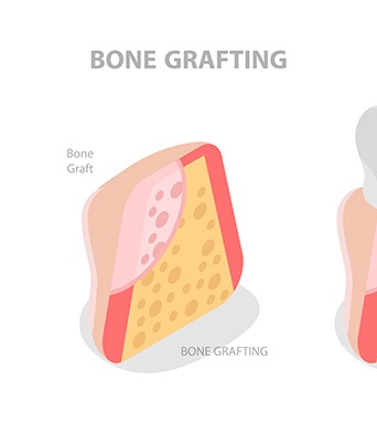 Bone grafting after tooth extraction