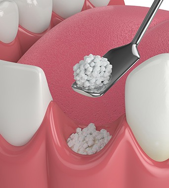 Bone grafting after tooth extraction