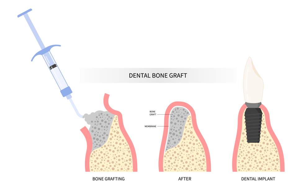 bone grafting for dental implants